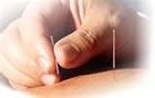 Traditional Chinese Acupuncture