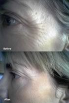 Cosmetic Acupuncture