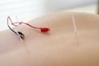 Electro-Acupuncture