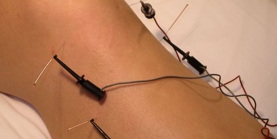 Electro Acupuncture in palm harbor