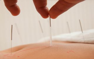 acupuncture-for-pain-in-Palm Harbor