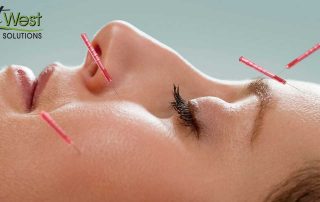acupuncture-for-migraines