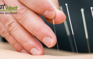 stress-relief-acupuncture