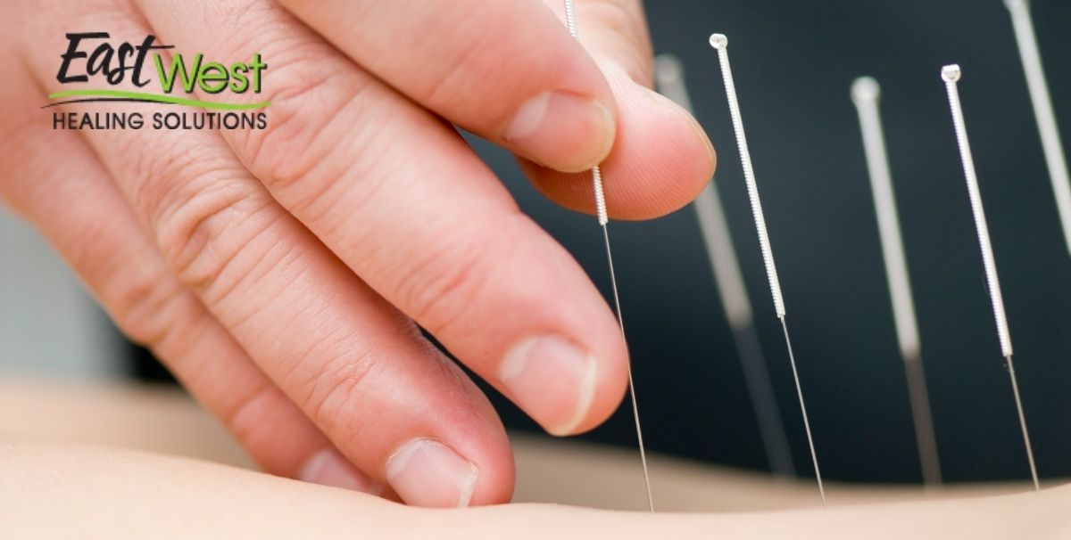 stress-relief-acupuncture