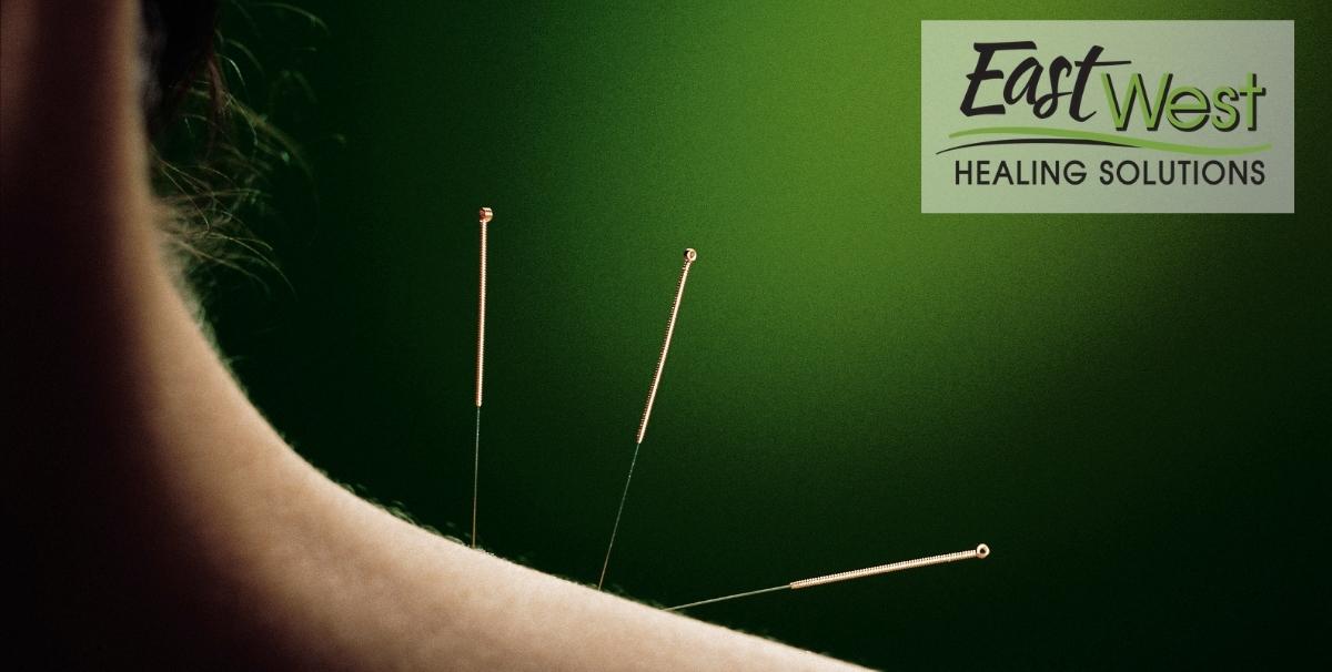 acupuncture-for-pinched-nerves