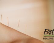 acupuncture-for-pain
