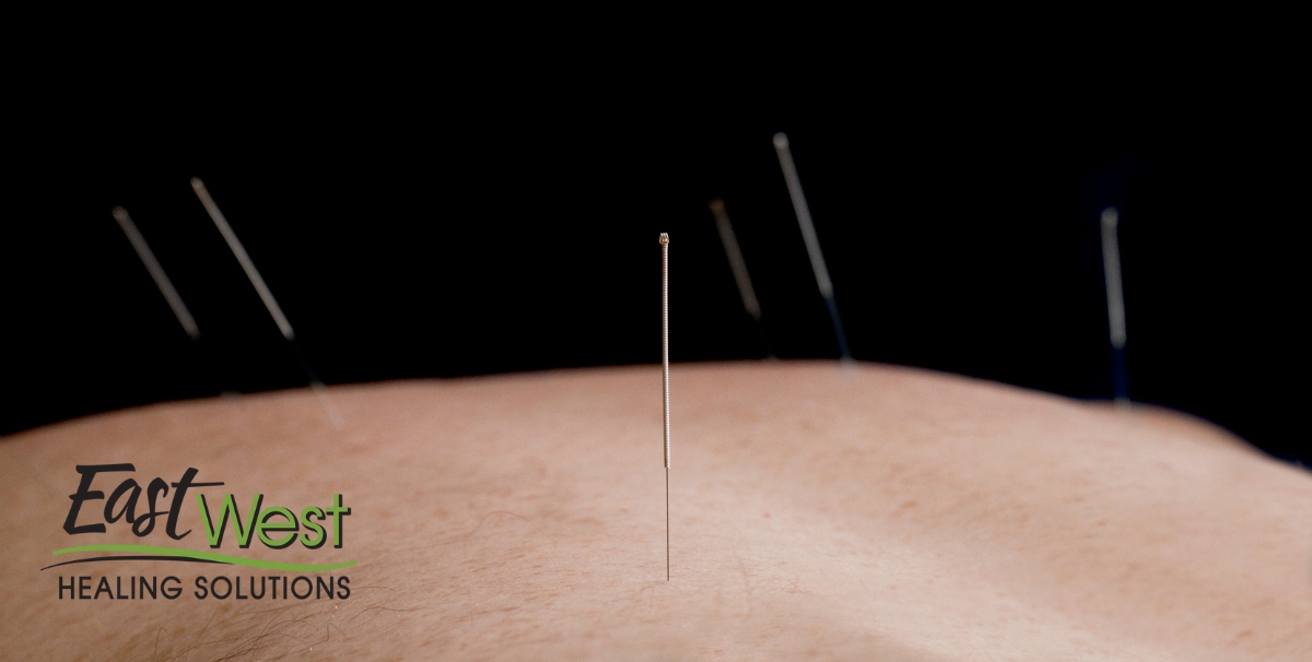 https://eastwesthealingsolutions.com/wp-content/uploads/2023/05/Does-Acupuncture-Hurt-How-do-Acupuncture-Needles-Feel.jpg