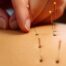 acupuncture-for-neuropathy