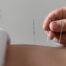 acupuncture-for-digestive-issues