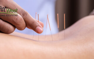 does-acupuncture-help-sciatica