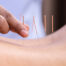 does-acupuncture-help-sciatica