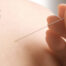 dry-needling-and-acupuncture-therapy